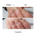 NAILSOFTHEDAY ONISTOP – regenerating oil for nails with onycholysis, 15 ml